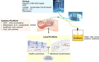 Biocompatible Peritoneal Dialysis: The Target Is Still Way Off